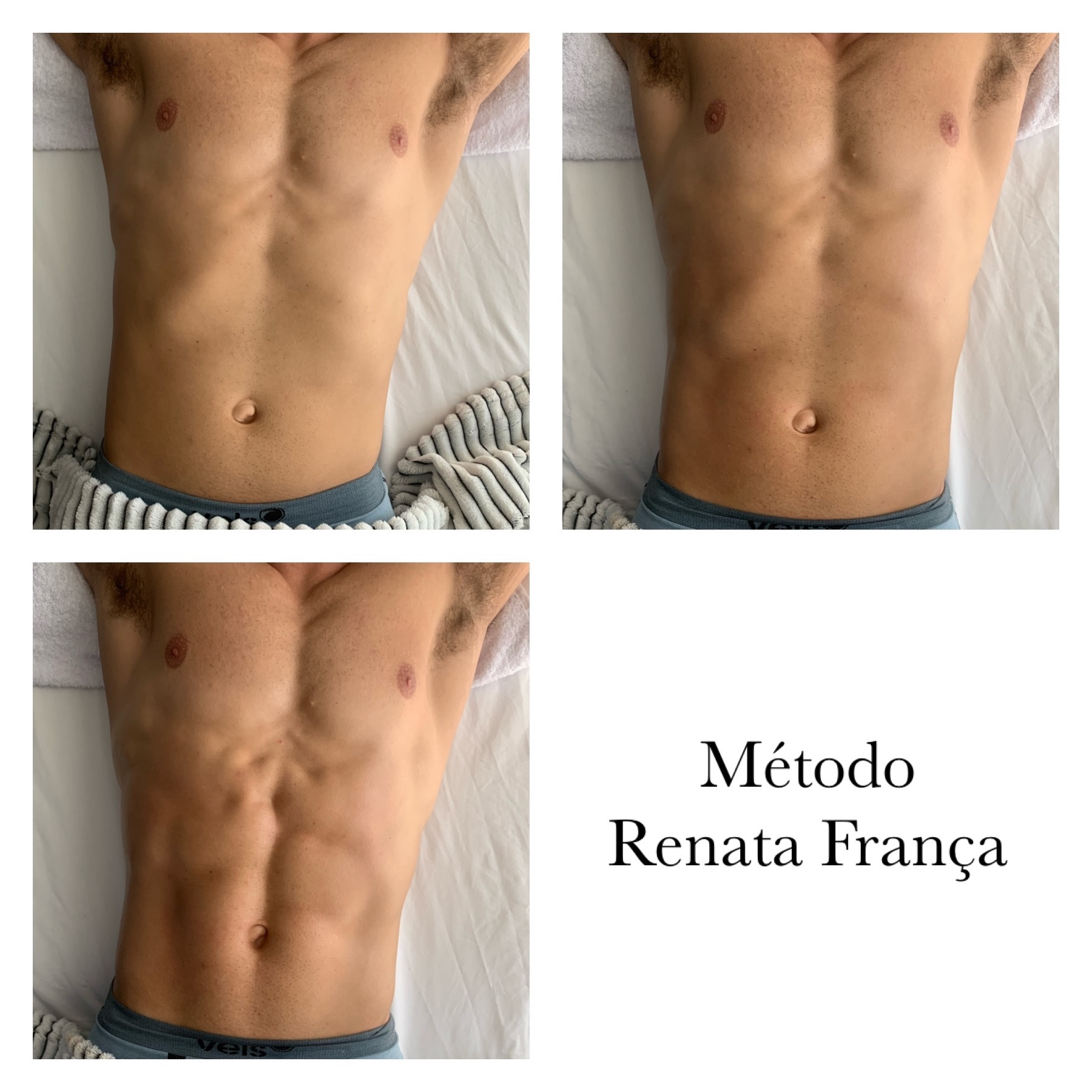 Antes e depois de massagem modeladora e drenagem - Cálita Massoterapeuta Palhoça SC