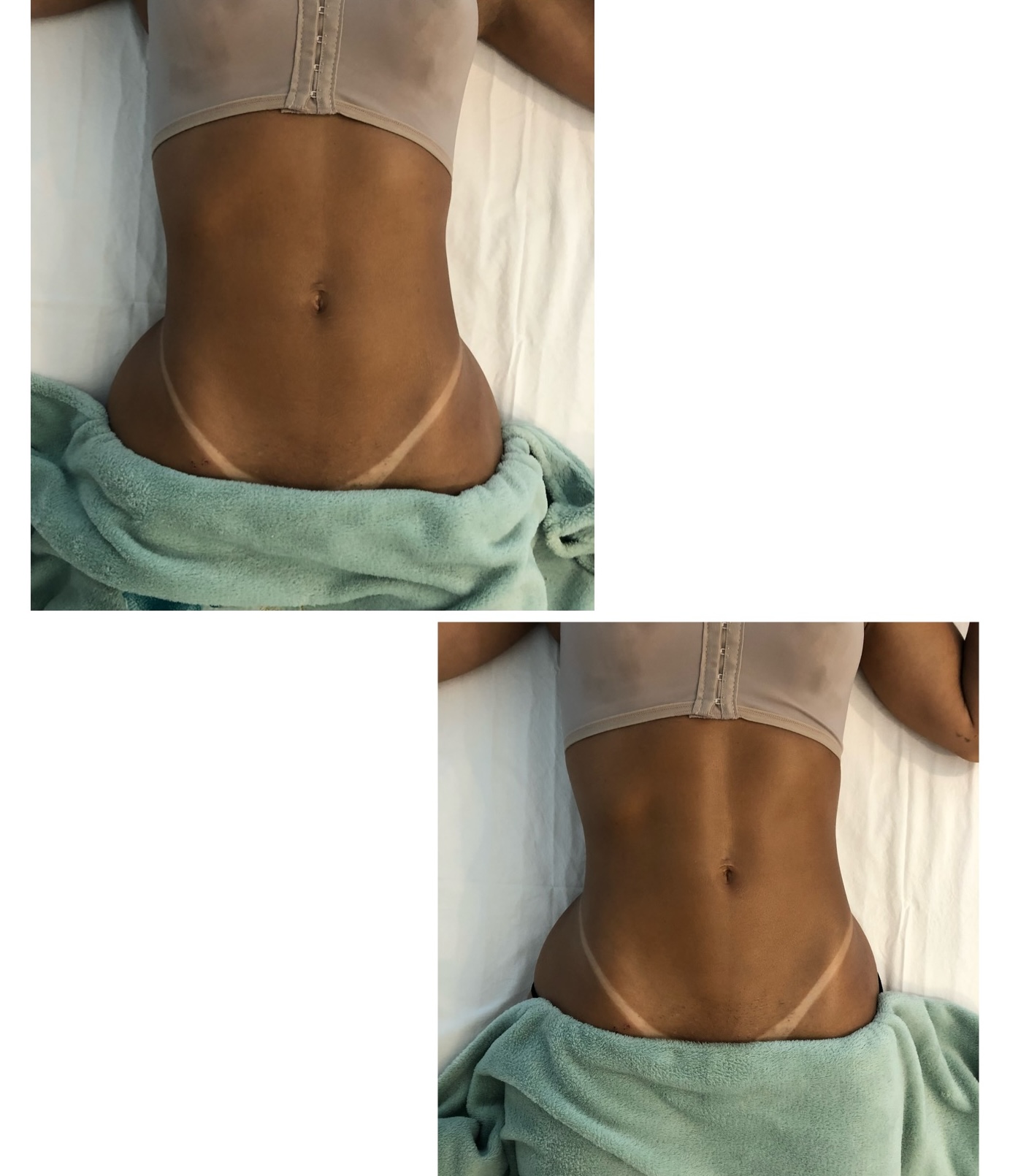 Resultado Método Renata França no abdômen - antes e depois - Palhoça SC