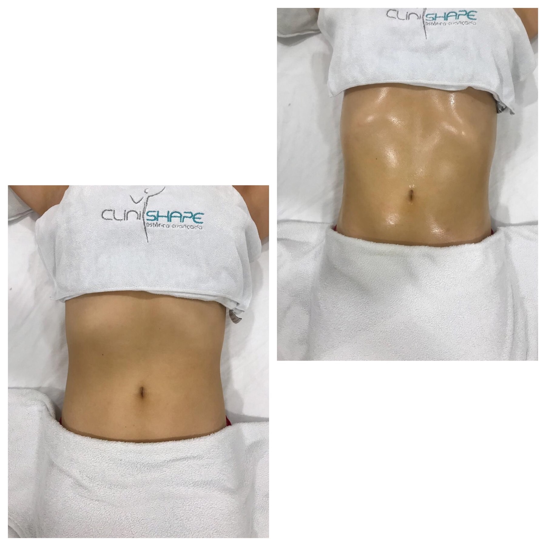 Antes e depois de drenagem linfática no abdômen - Cálita Massoterapeuta
