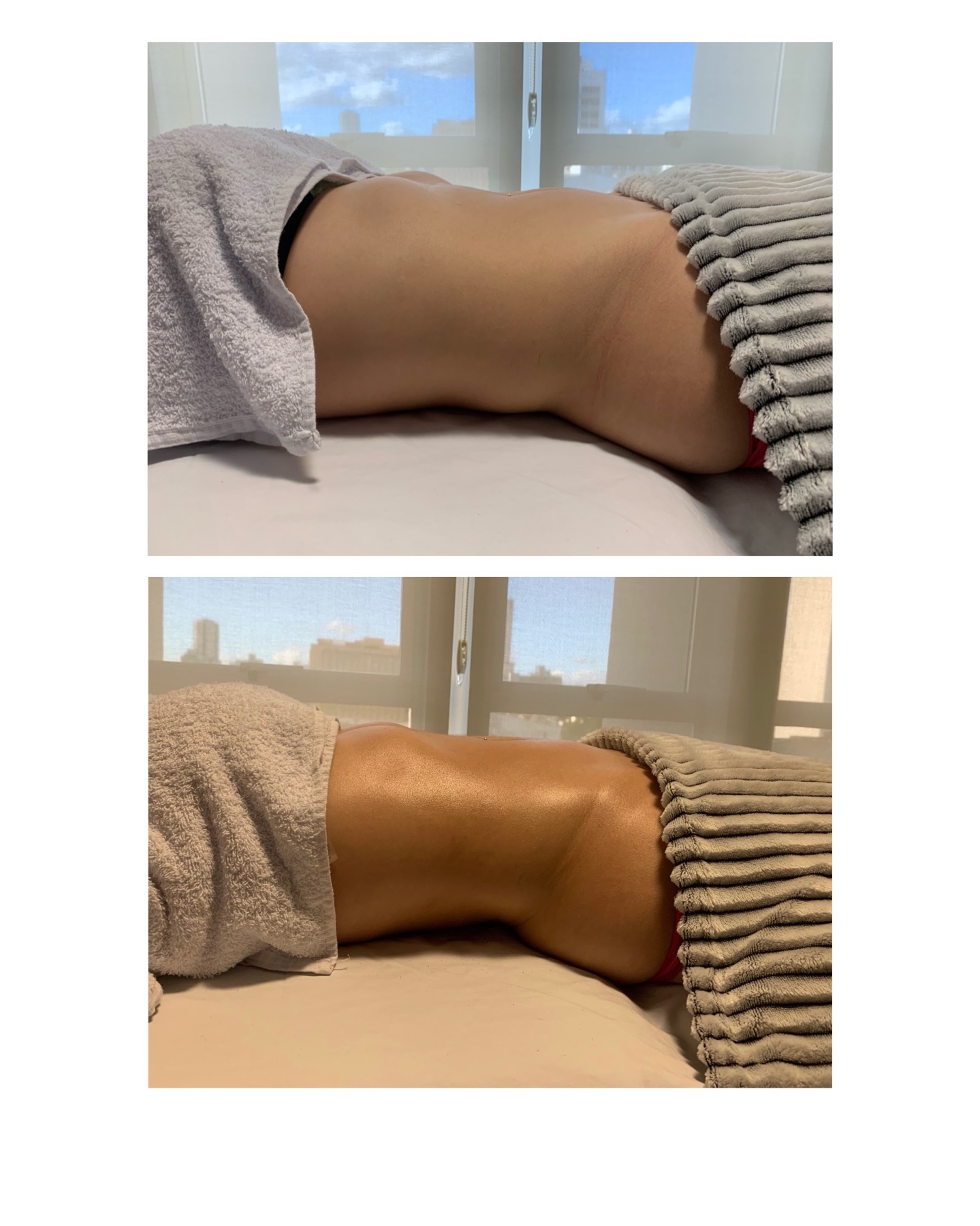 Resultado de massagem modeladora - redução de inchaço - Palhoça SC