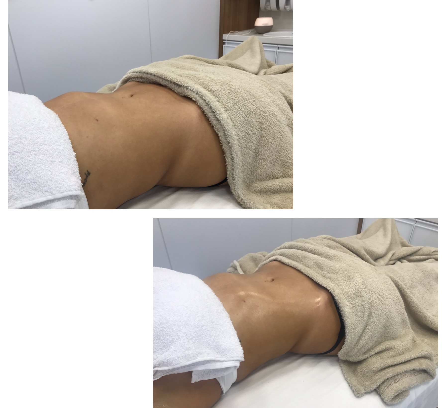 Antes e depois de massagem estética no abdômen - Método Renata França